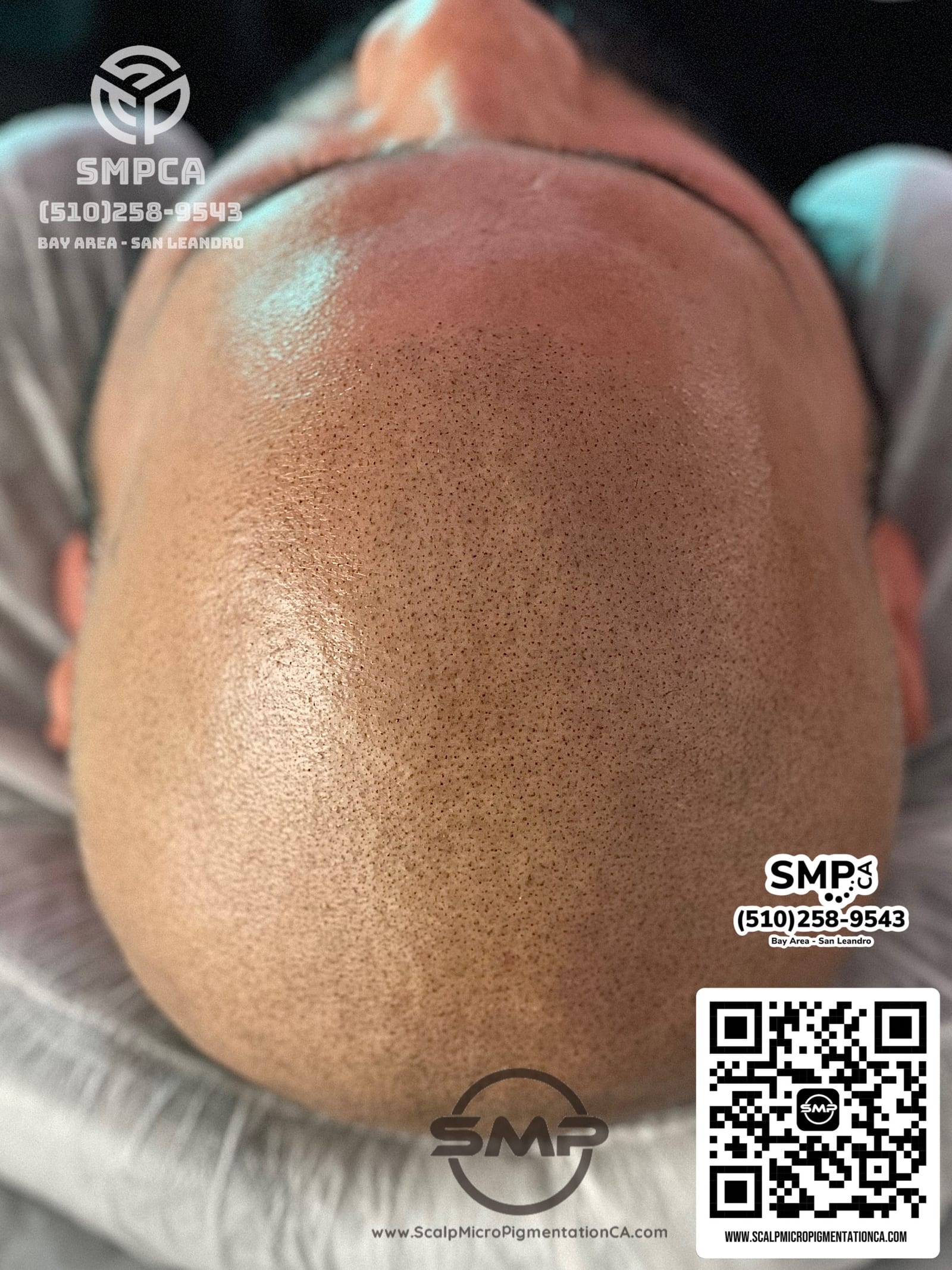 Rebuilt natural hairline — after scalp micropigmentation by Joe V. Nguyen, SMPCA San Lorenzo