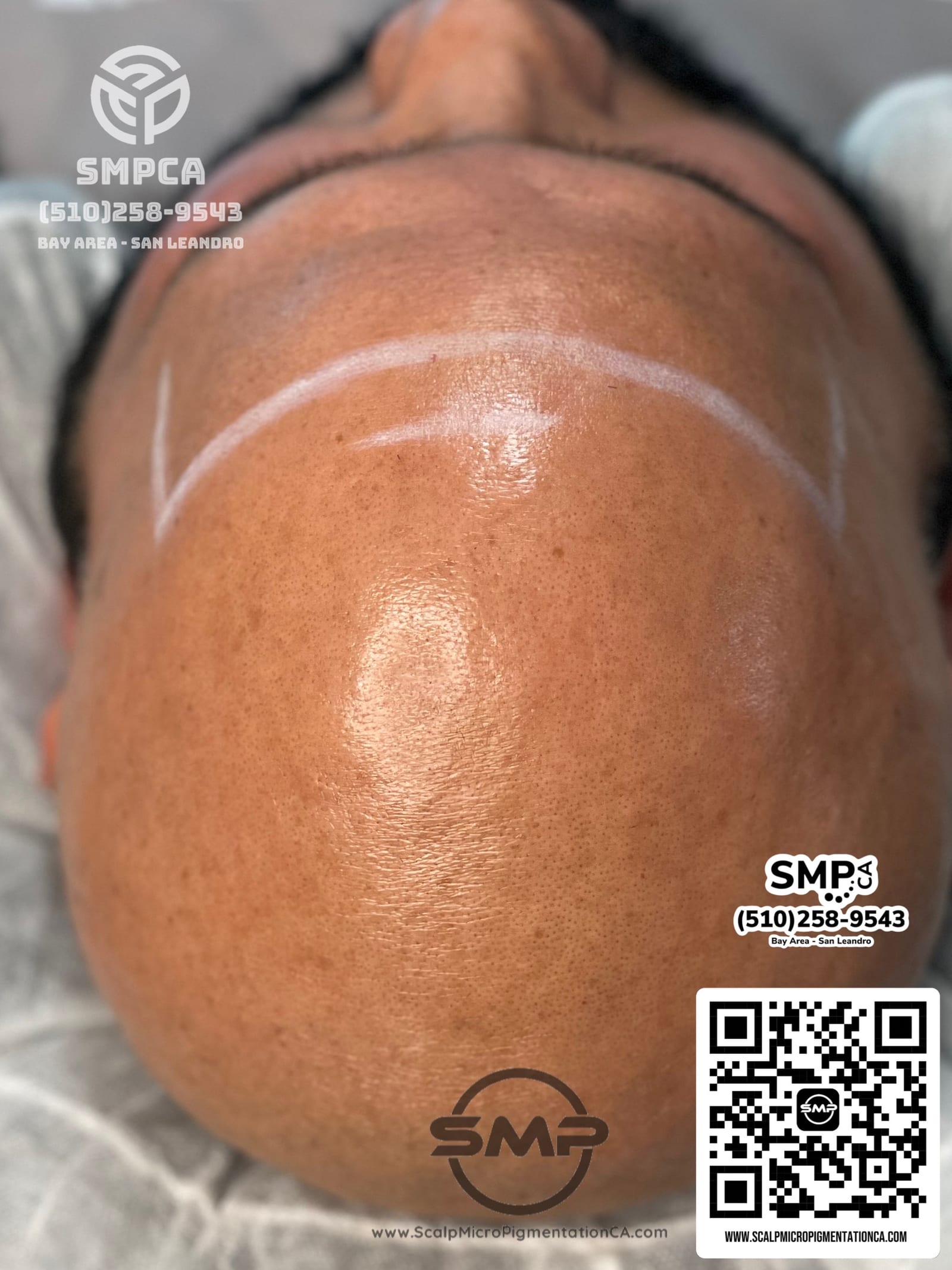 Receded hairline mapped for restoration — before scalp micropigmentation by Joe V. Nguyen, SMPCA San Lorenzo