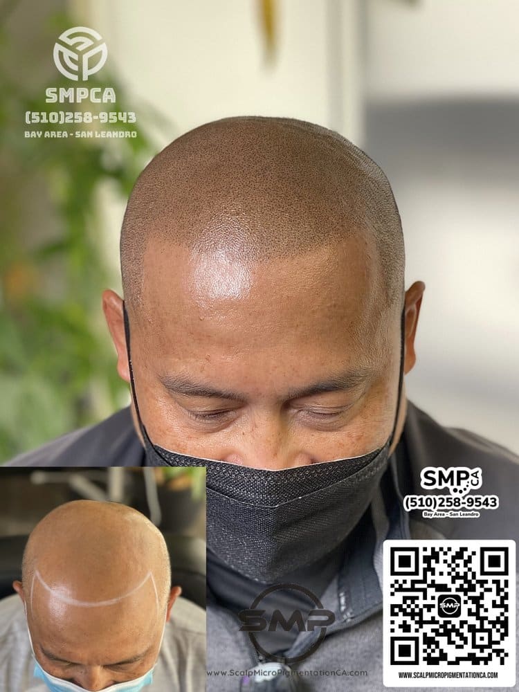 SMPCA scalp micropigmentation transformation 2 by Joe V. Nguyen, San Lorenzo CA