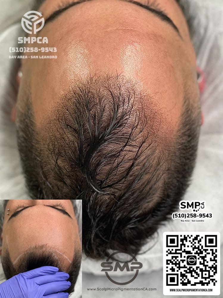 SMPCA scalp micropigmentation transformation 4 by Joe V. Nguyen, San Lorenzo CA