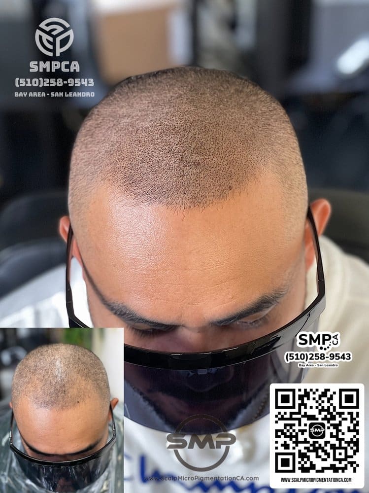 SMPCA scalp micropigmentation transformation 7 by Joe V. Nguyen, San Lorenzo CA