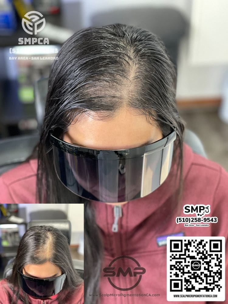 SMPCA scalp micropigmentation transformation 13 by Joe V. Nguyen, San Lorenzo CA
