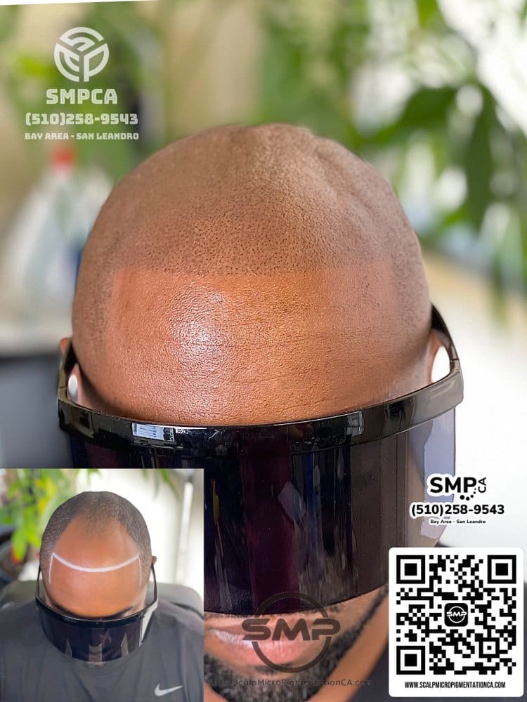 SMPCA scalp micropigmentation transformation 15 by Joe V. Nguyen, San Lorenzo CA