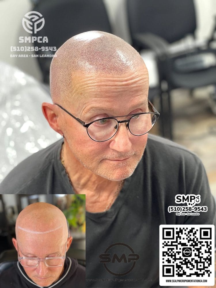 SMPCA scalp micropigmentation transformation 18 by Joe V. Nguyen, San Lorenzo CA