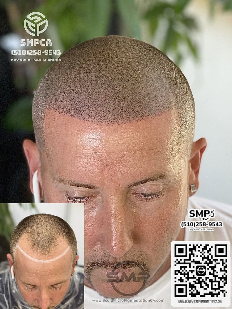 SMPCA scalp micropigmentation transformation 19 by Joe V. Nguyen, San Lorenzo CA