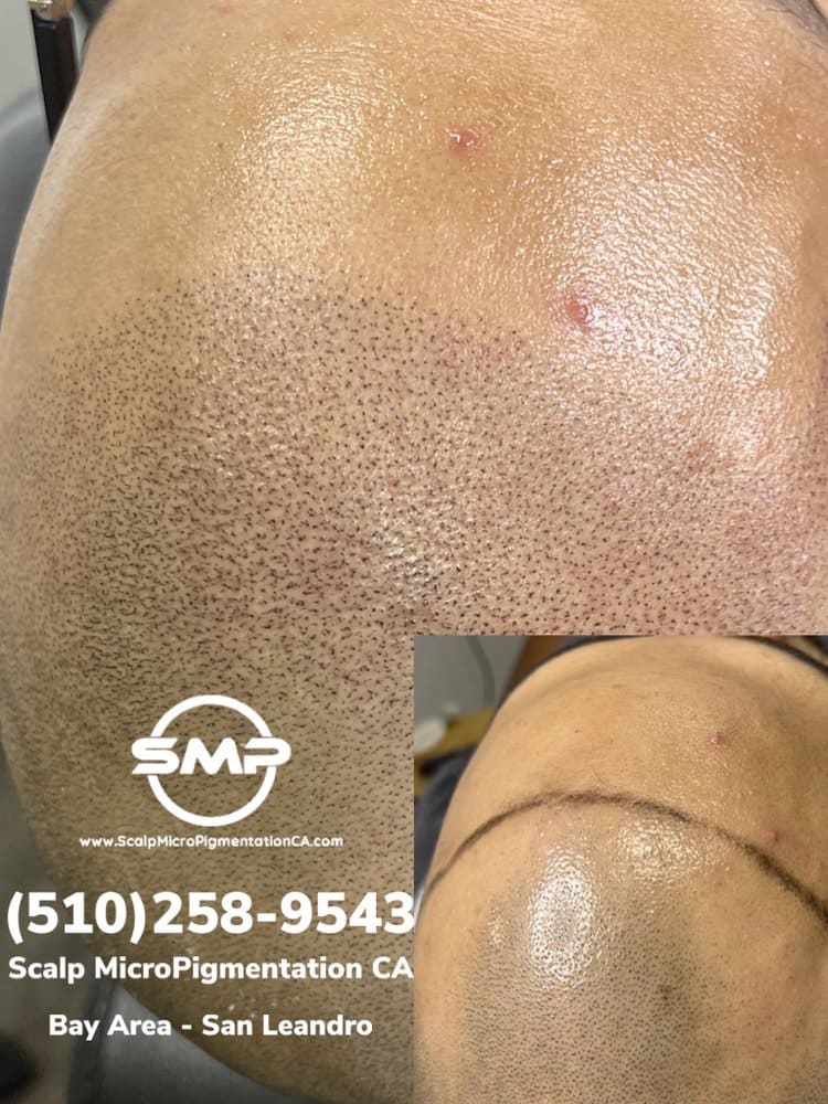 SMPCA scalp micropigmentation transformation 25 by Joe V. Nguyen, San Lorenzo CA