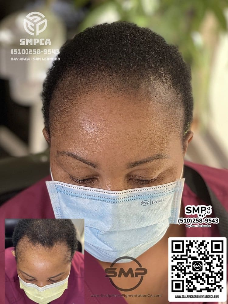 SMPCA scalp micropigmentation transformation 27 by Joe V. Nguyen, San Lorenzo CA