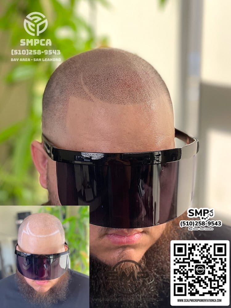 SMPCA scalp micropigmentation transformation 29 by Joe V. Nguyen, San Lorenzo CA