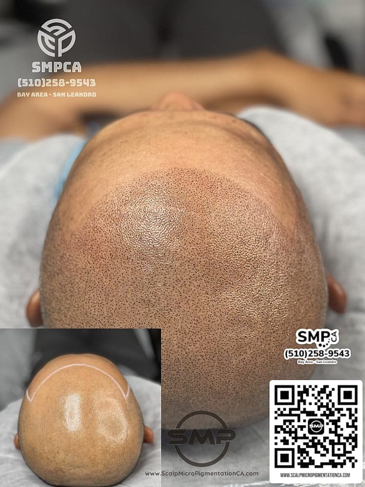 SMPCA scalp micropigmentation transformation 34 by Joe V. Nguyen, San Lorenzo CA