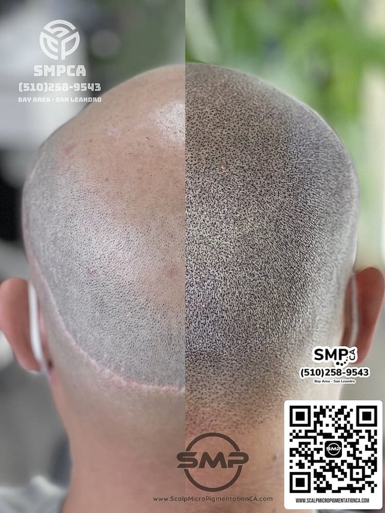 SMPCA scalp micropigmentation transformation 46 by Joe V. Nguyen, San Lorenzo CA