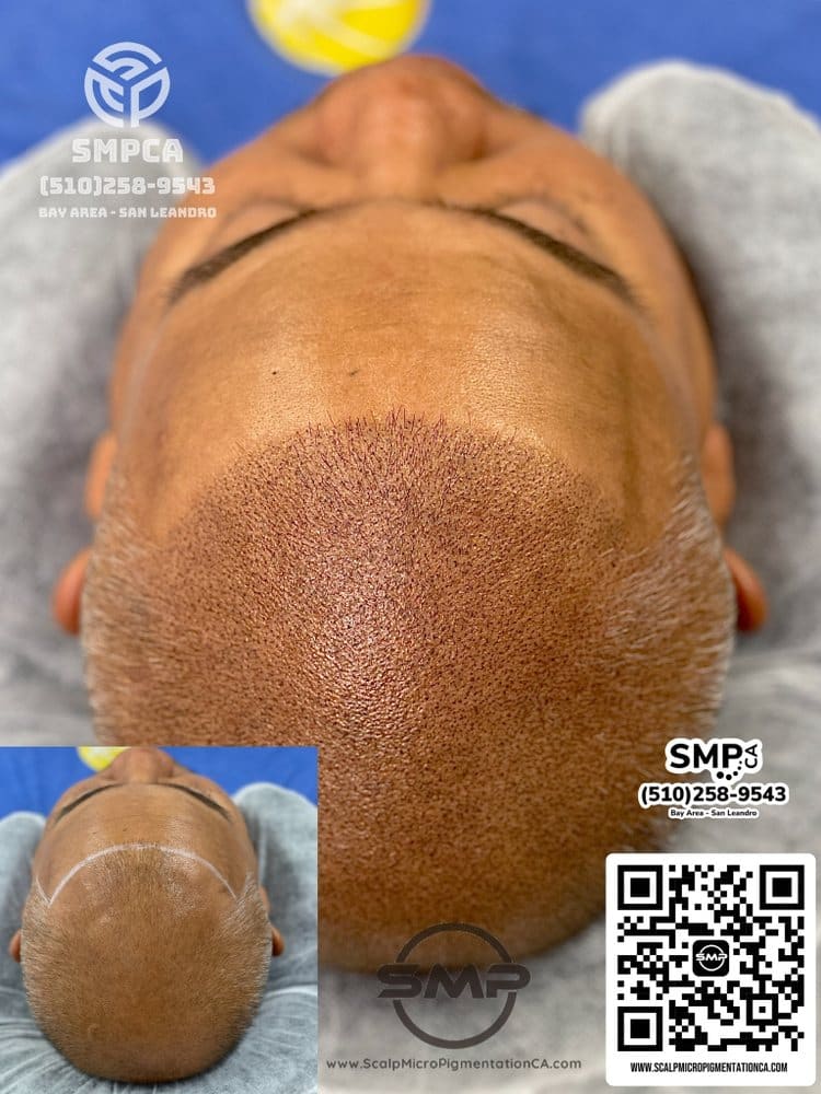 SMPCA scalp micropigmentation transformation 49 by Joe V. Nguyen, San Lorenzo CA