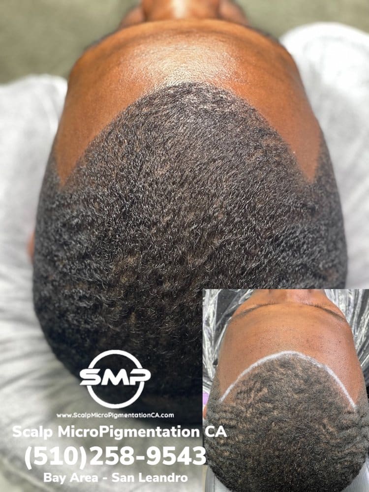 SMPCA scalp micropigmentation transformation 60 by Joe V. Nguyen, San Lorenzo CA