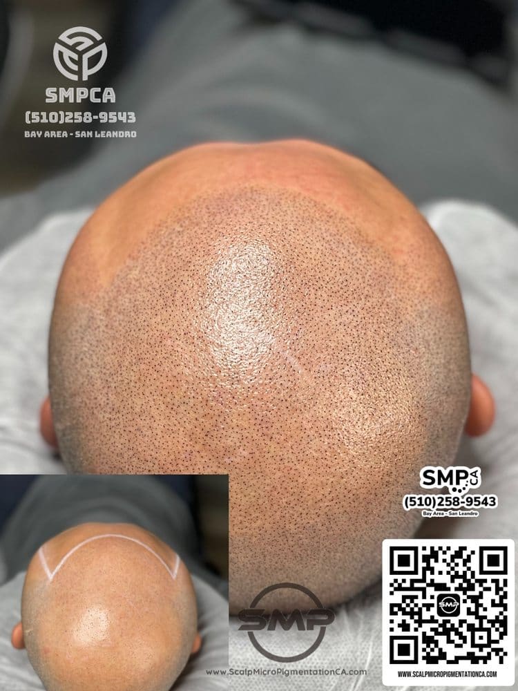 SMPCA scalp micropigmentation transformation 61 by Joe V. Nguyen, San Lorenzo CA