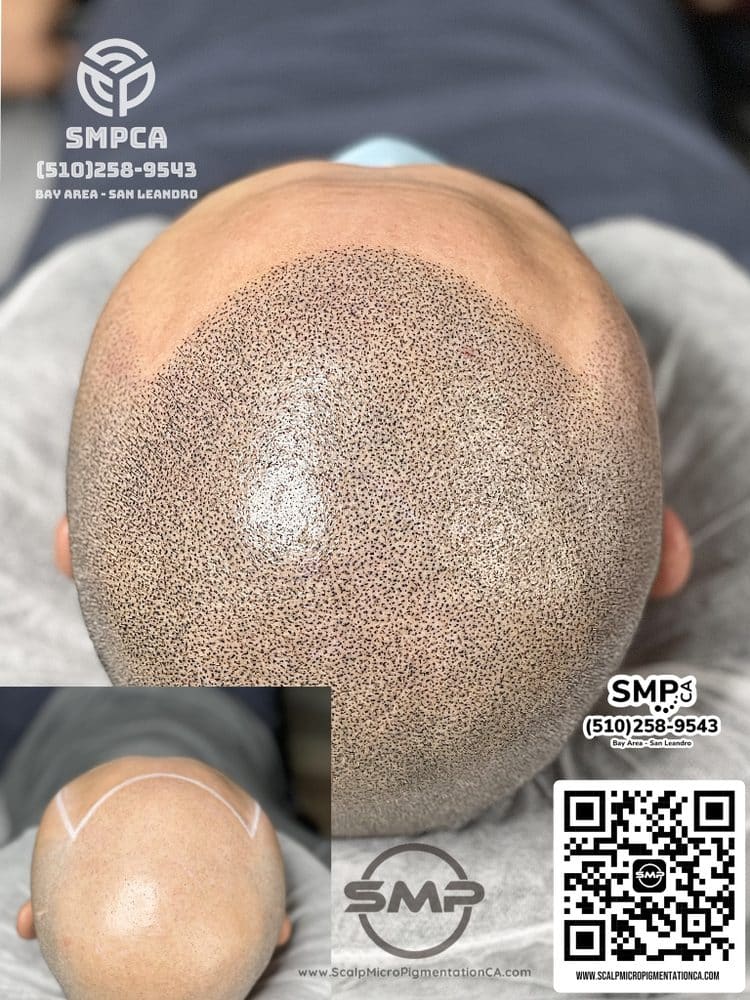 SMPCA scalp micropigmentation transformation 62 by Joe V. Nguyen, San Lorenzo CA