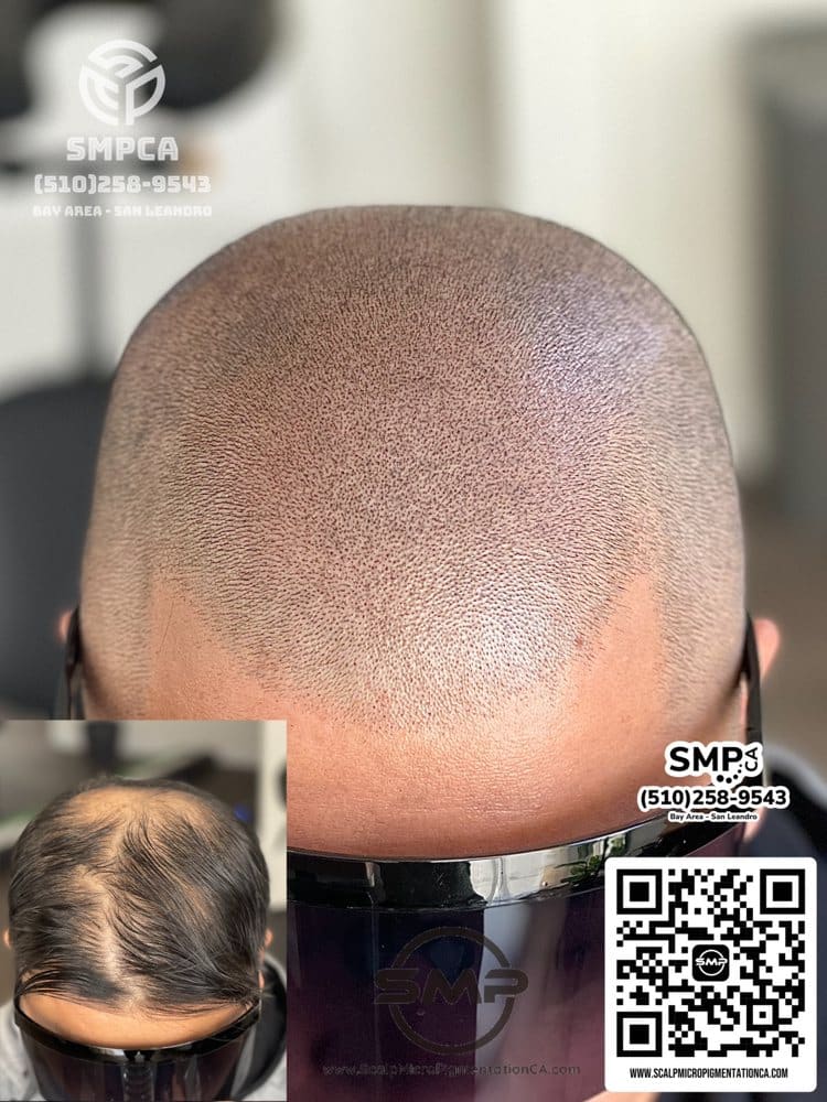 SMPCA scalp micropigmentation transformation 67 by Joe V. Nguyen, San Lorenzo CA