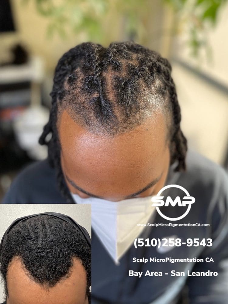 SMPCA scalp micropigmentation transformation 68 by Joe V. Nguyen, San Lorenzo CA