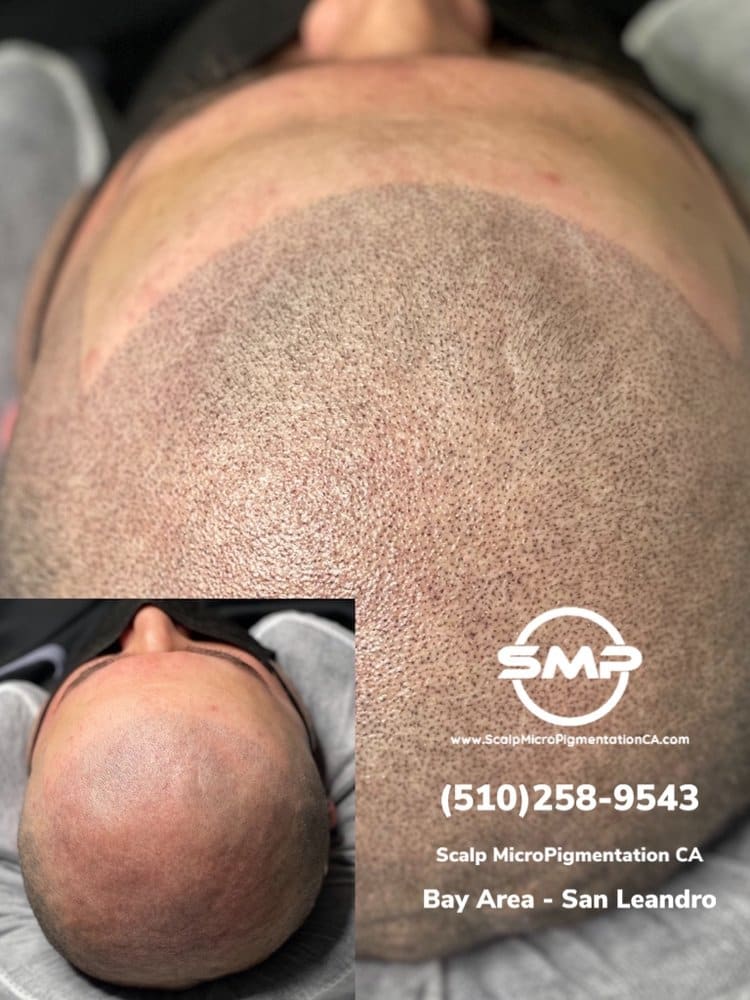 SMPCA scalp micropigmentation transformation 71 by Joe V. Nguyen, San Lorenzo CA